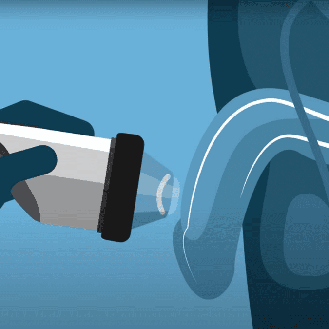 Få et bedre sexliv med shockwave mod erektil dysfunktion